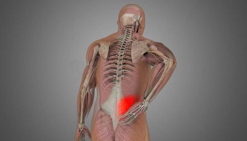 Back Sprain