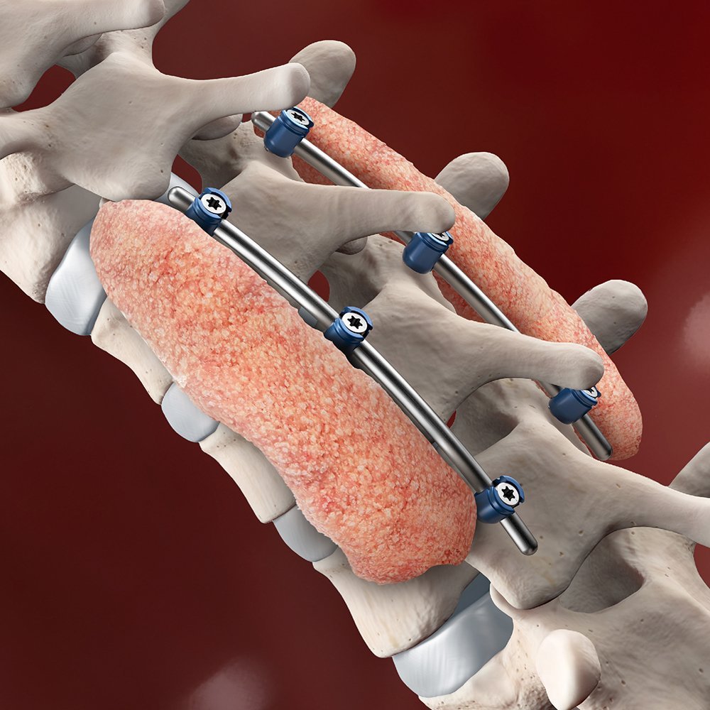 Osteoporosis