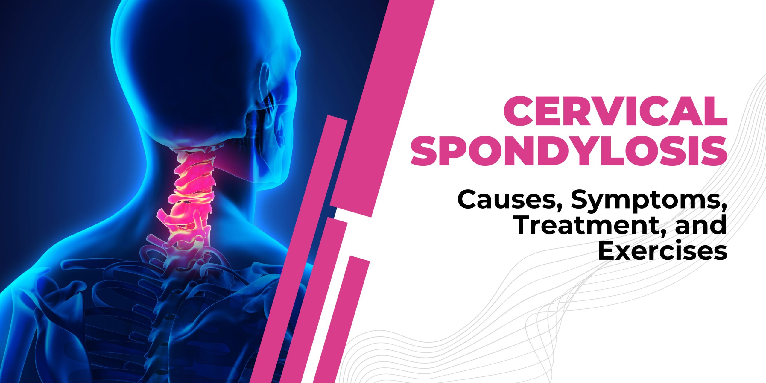 Cervical Spondylosis: Causes, Symptoms, Treatment, and Exercises