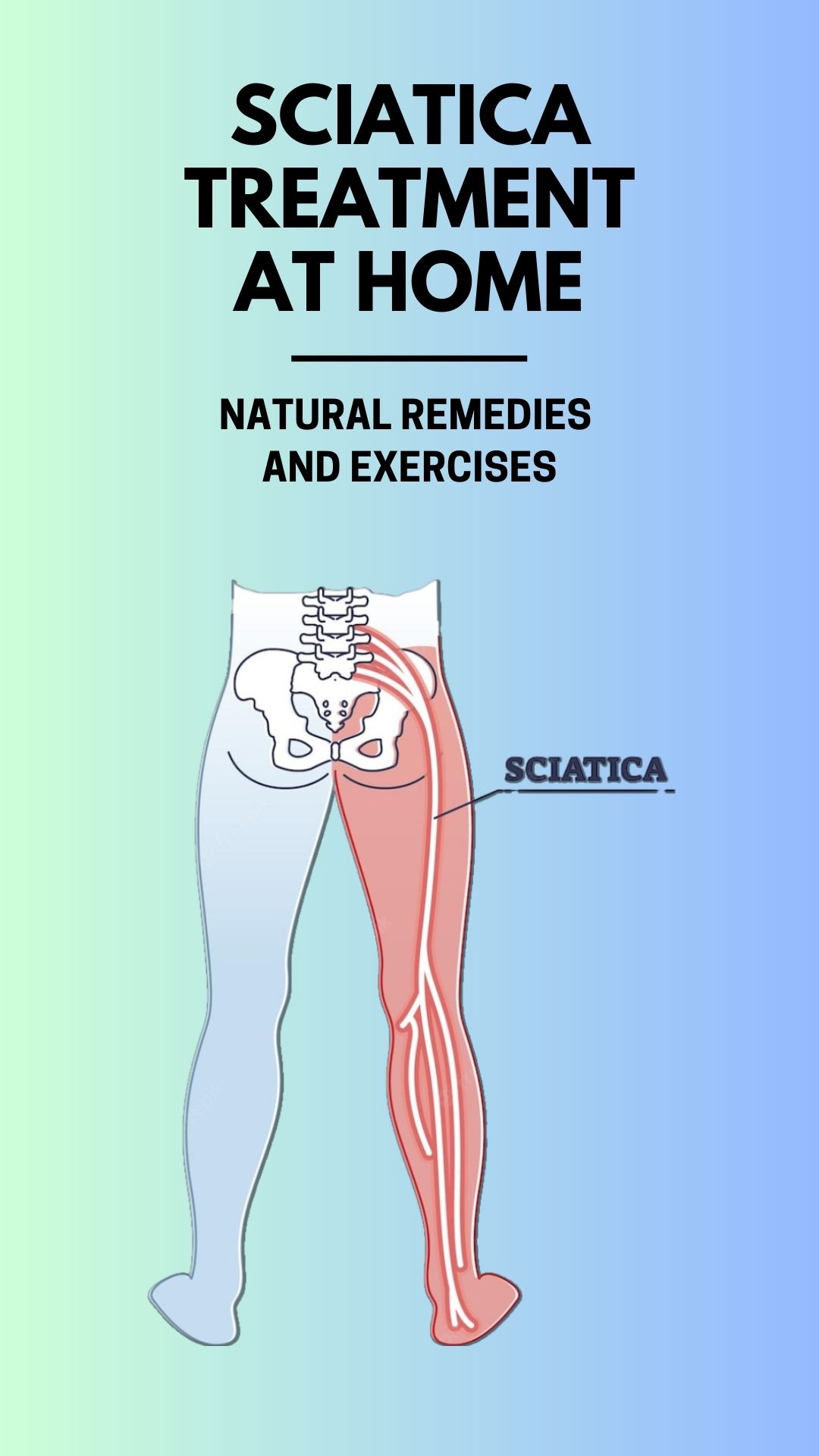 Sciatica treatment at home We Are Spine