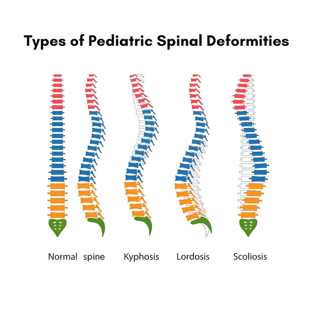 Types of Pediatric Spinal Deformities