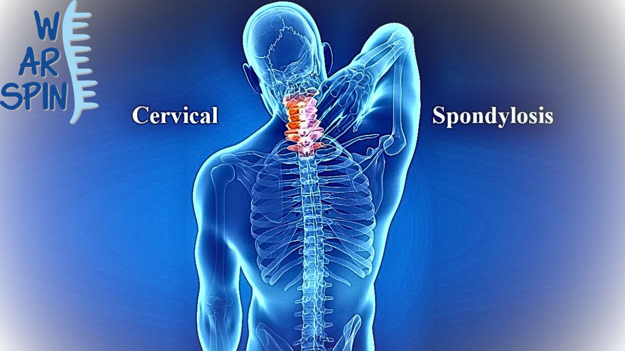 Cervical Spondylosis: Symptoms, Causes & Treatment
