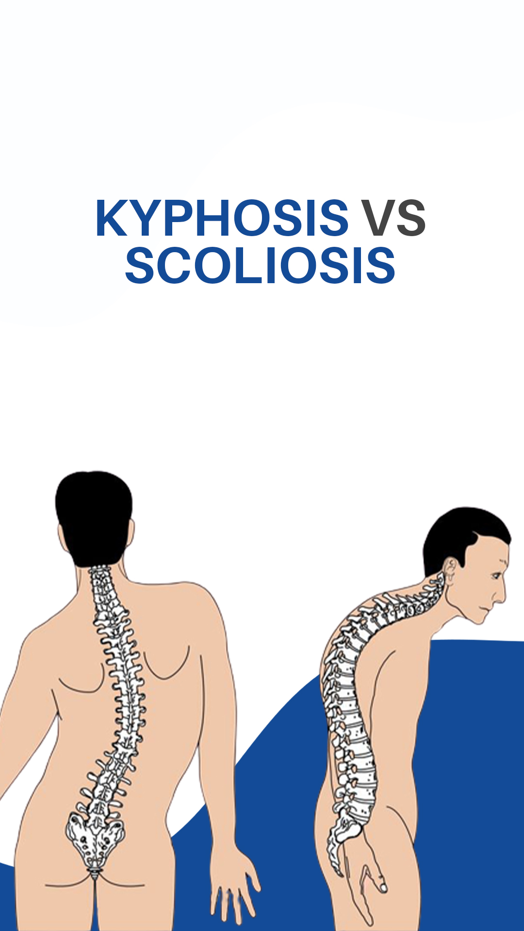 Kyphosis vs. Scoliosis