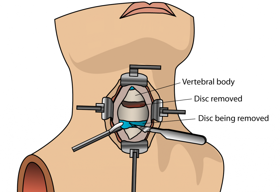 Cervical Spine Surgery - Microdiscectomy