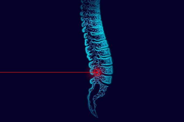 Laser spine Surgery