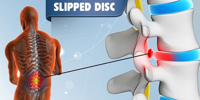 Slip disc Surgery (Herniated disc)